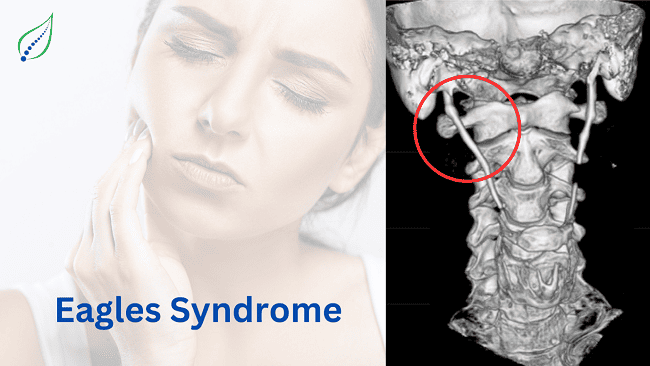 Eagle's syndrome